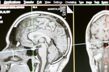 MRI scan of a human head showing the brain in profile